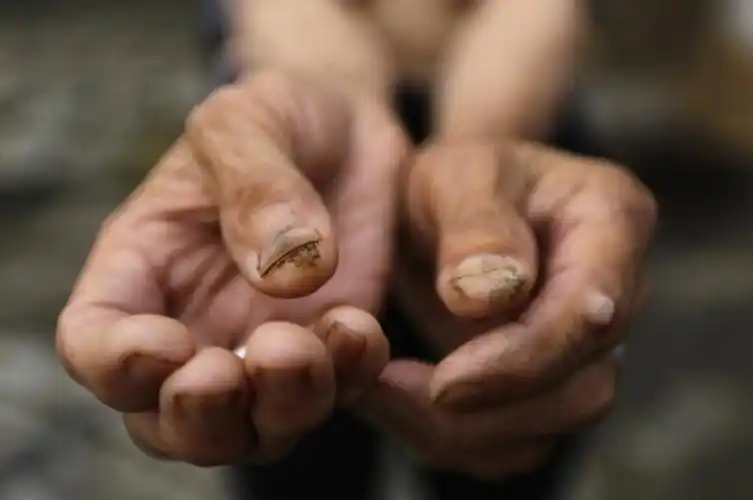 6月4日,湖南鹤山村,78岁的皮肤癌患者秦正玉向摄影师展示手指上的