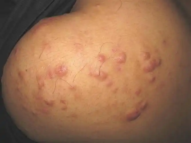 面部有轻度结节痤疮图片_有来医生