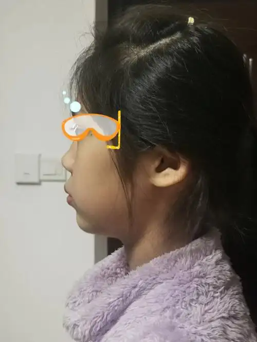 小妞这样有没有下巴后缩腺样体面容