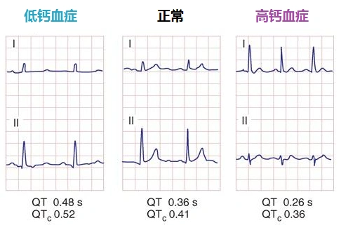 与正常心电图比较,低钙血症qt间期延长,高钙血症qt间期缩短,st-t波