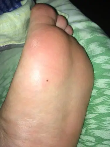 脚底突然长了个黑点,请问是不是什么黑色素瘤或者皮肤癌啊前兆啊?