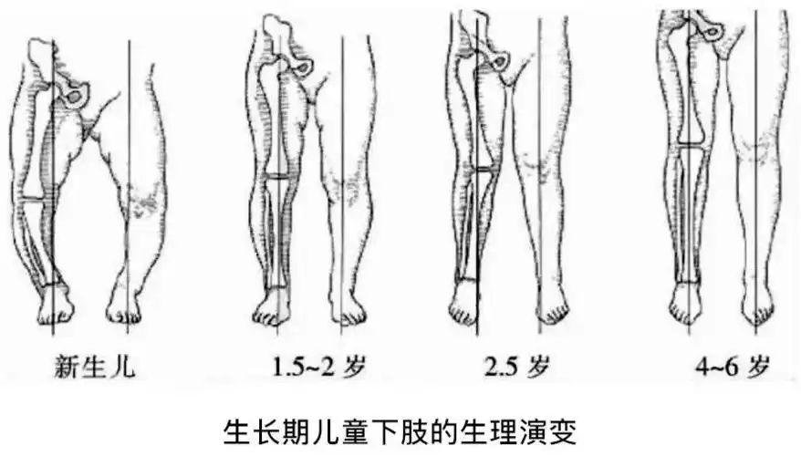 如超过2岁还有明显o型腿才应考虑是骨骼发育问题